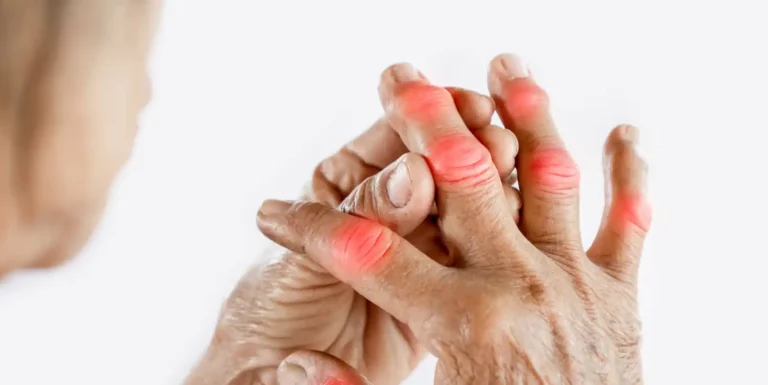 Señales tempranas de la artritis